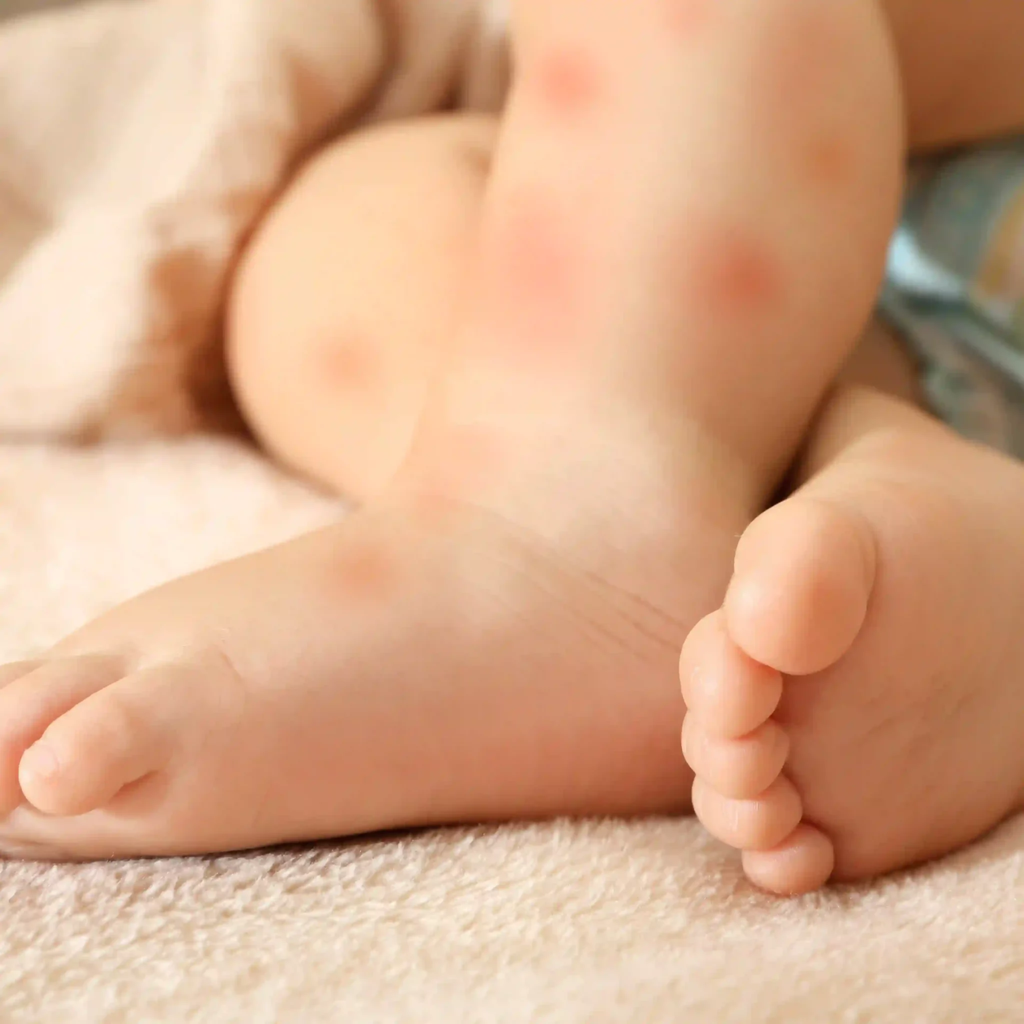 peau atopique enfant routine