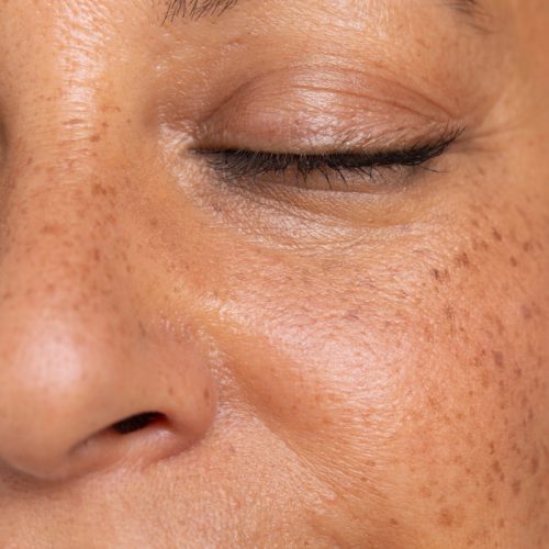 peau grasse article Klapotis